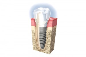 зъбни имплантати