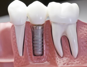 импланти за зъби