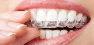 избелване на зъби с гел